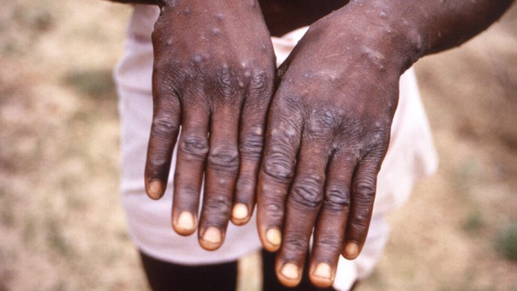 Mpox cases in Africa approach 30,000 mark: Africa CDC